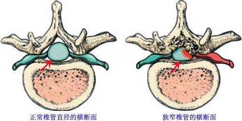 腰间盘为何如此突出？该如何治疗，要手术吗，骨科医生告诉你