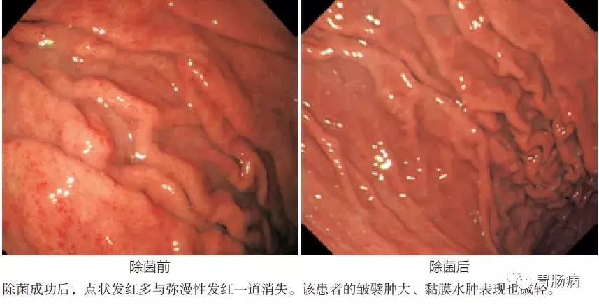 慢性浅表性（非萎缩性）胃炎