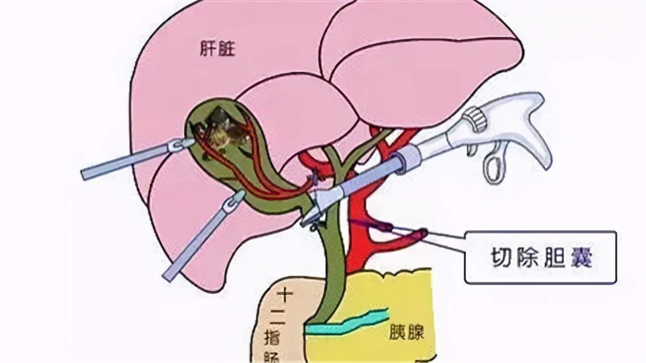 胆囊切除对身体有何影响？后遗症不好受，除非万不得已，别切