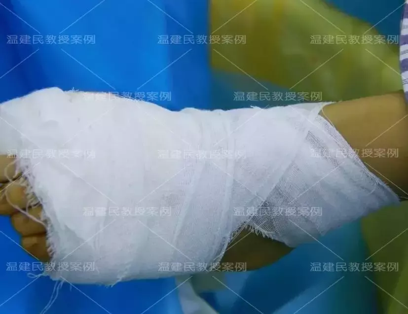 这位患者拇外翻拖了20年,畸形疼痛越来越重,10分钟手术就矫正
