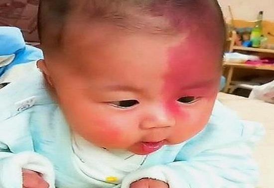 胎记怎么来的，只是遗传吗，产科医生：还和孕期的这3种行为有关