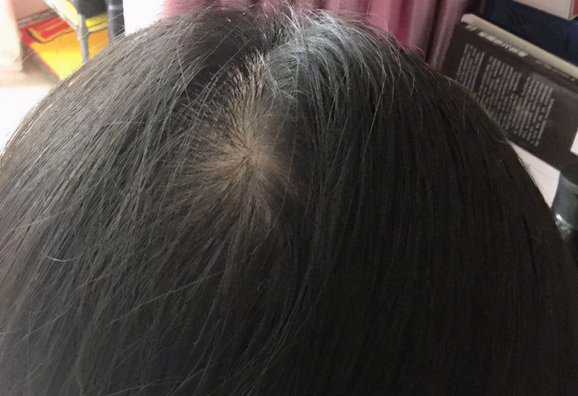 头发细软是天生的吗？怎么改善？