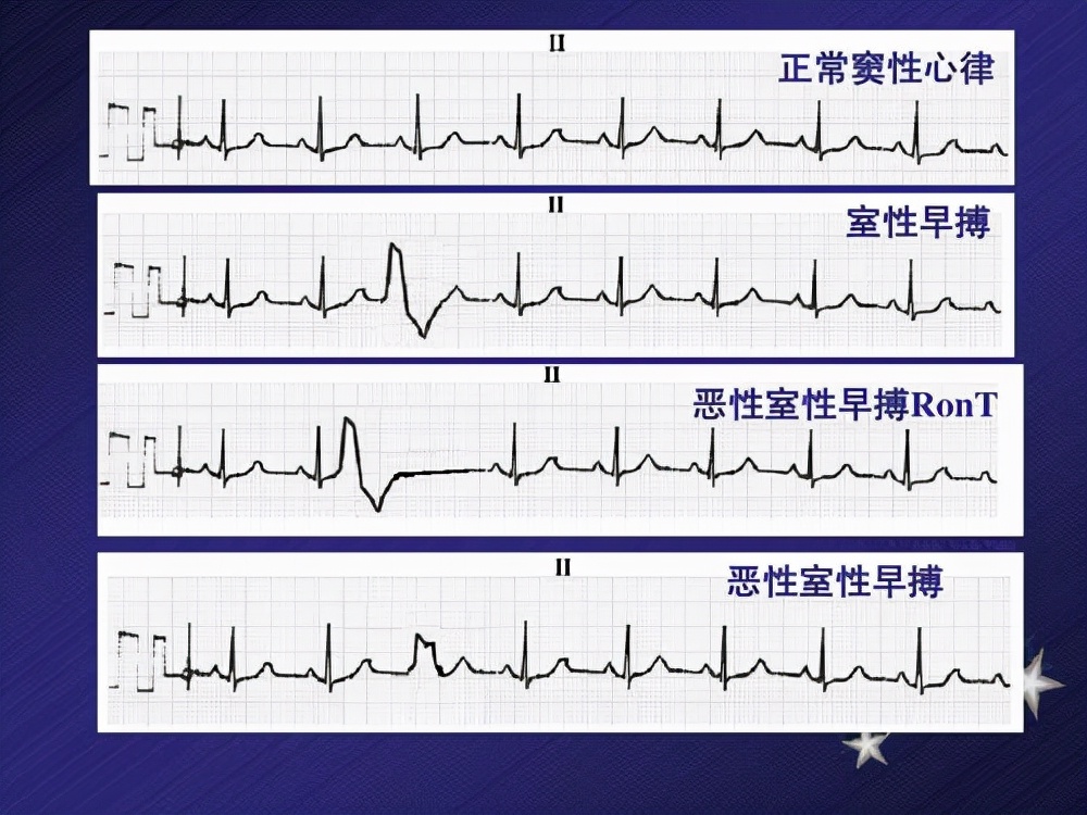 心电图如何诊断图片