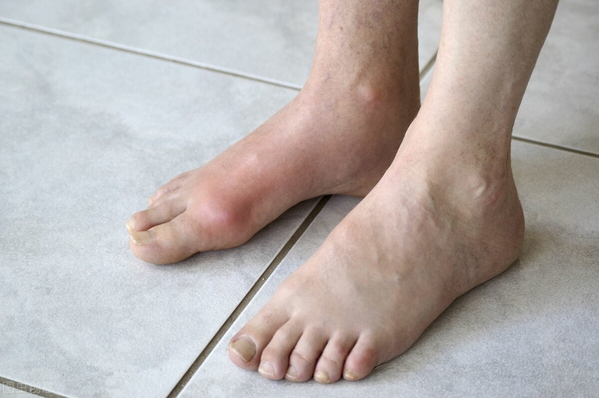 出现这些症状,说明痛风肾已找上门