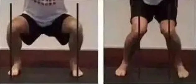 看完这篇,轻松甩掉X型腿