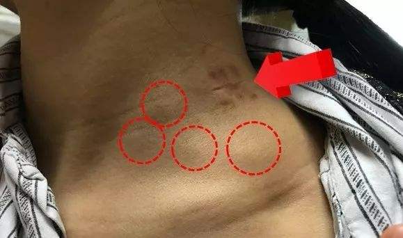 辟谣！淋巴肿大是毒素排不出去？如何快速排毒消肿？医生告诉你