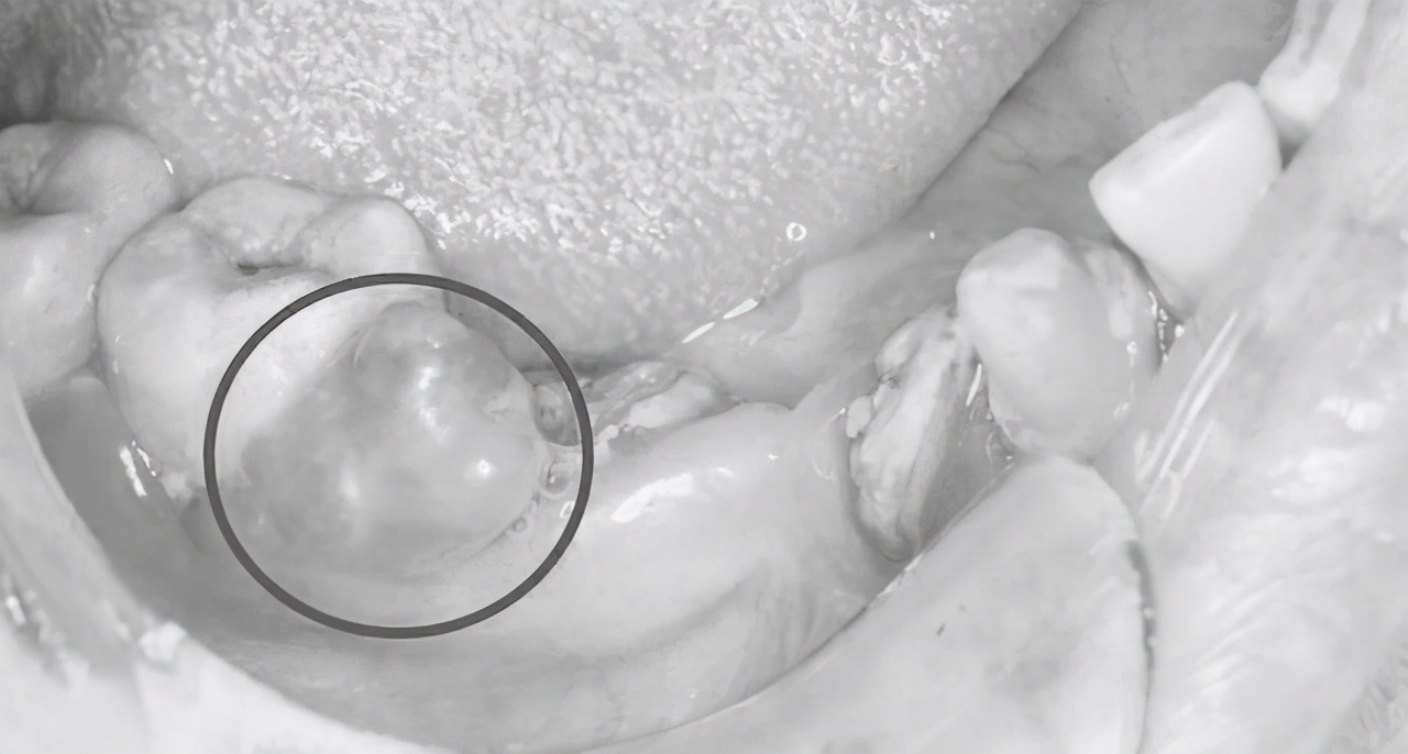 牙龈长了个肉疙瘩图片(牙龈长了一个小疙瘩) - 赤虎壹号