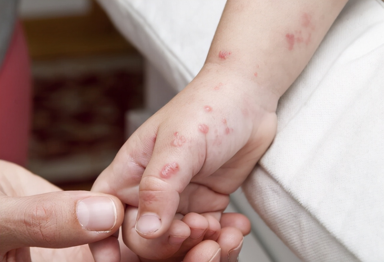 别错把"艾滋"当成皮肤病,身体如果出现5种症状,尽量不要忽视