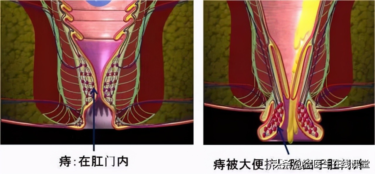 孕期痔疮脱出肛门外如何处理