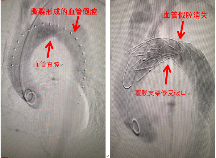 介入就是放支架？NO！NO！不要把我们想的太简单