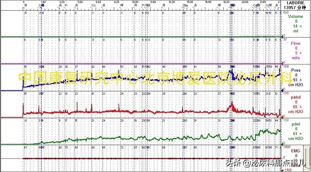 肠道膀胱扩大典型病例解析 | 神经源性下尿路功能障碍专栏 027