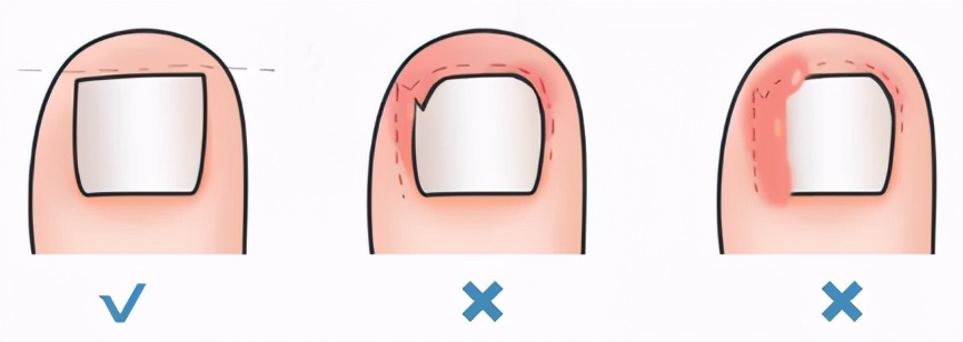 皮肤科普:甲沟炎,嵌甲,疼痛难忍,影响行动,一定要拔甲吗?