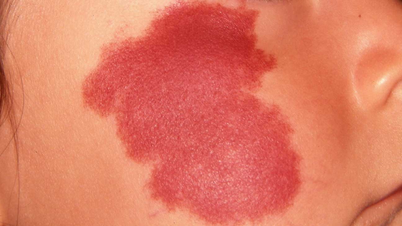 男人脖子前面有痣代表什么 脖子上长红痣命理解析_达一风水网