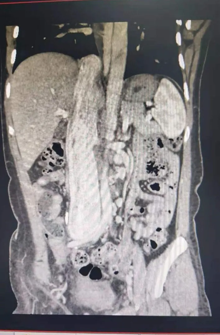 “小腿般”的肿瘤竟“藏”胸中！“MDT”为手术保驾护航
