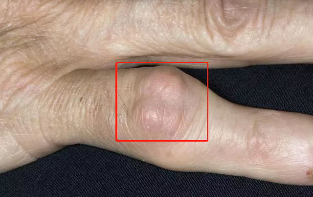 痛风石的3个阶段,看看你在哪里?专家:防治还要注意这几点