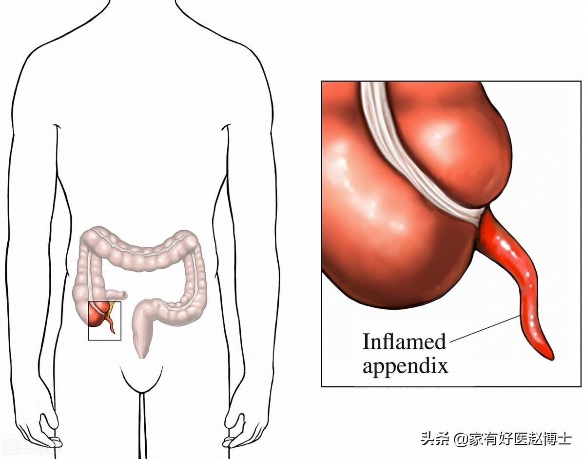 常被“拿掉”的四种器官，一般为何要切？切除以后会有哪些影响？