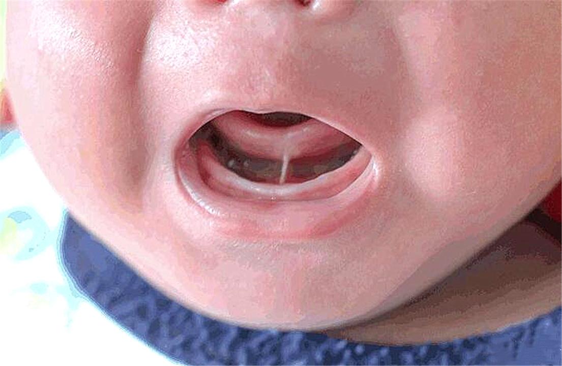 婴儿舌头下面长小垫舌(2) 