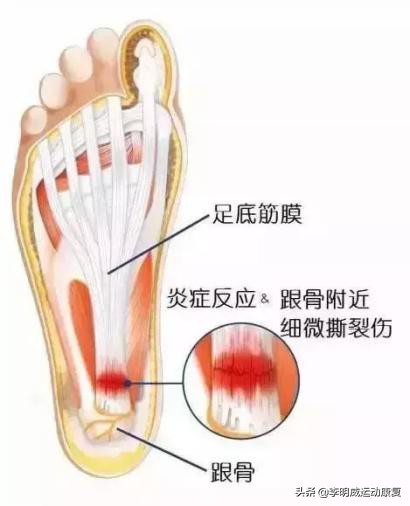 经常脚疼？可能和你脚底的一根筋有关