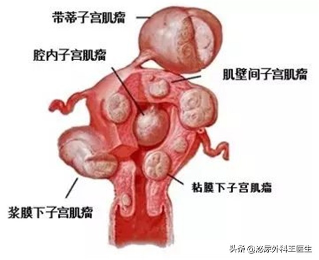 女人切除子宮，对性生活有什么影响呢？