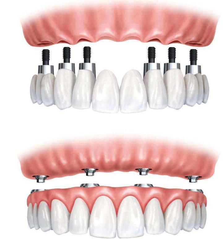 半口缺牙患者的福音，ALL ON 4技术到底怎么样？听听牙医的分析