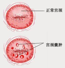 宫颈囊肿听着吓人，但没那么严重，医生建议采用两种手段治疗