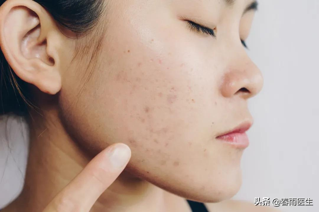 网红狂吹的“壬二酸”真是抗痘神器？那它这么多年咋默默无闻