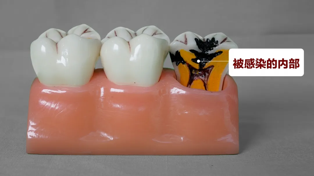 根管治疗是不是就是“杀神经”?