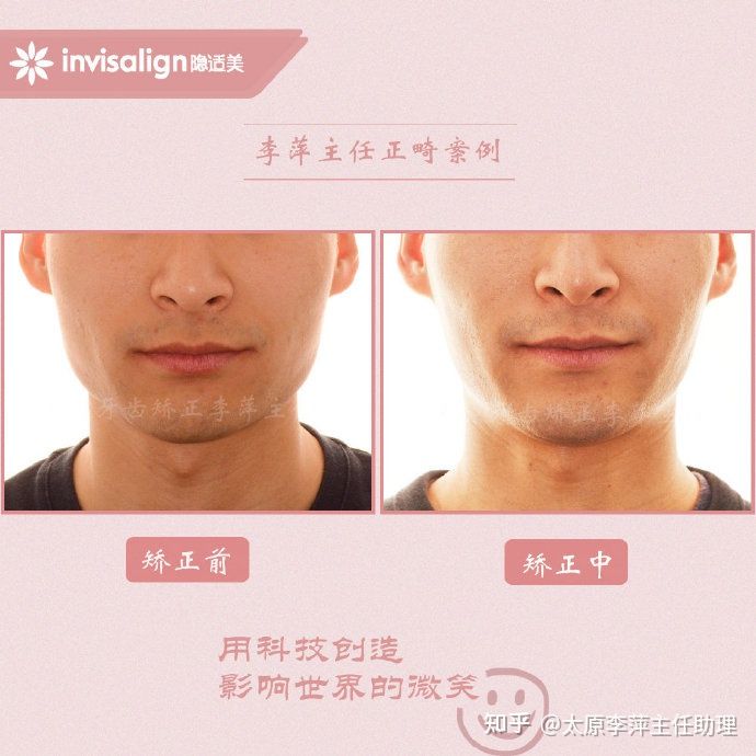 太原牙齿矫正：隐形牙套效果好不好？看这些病例你就知道了