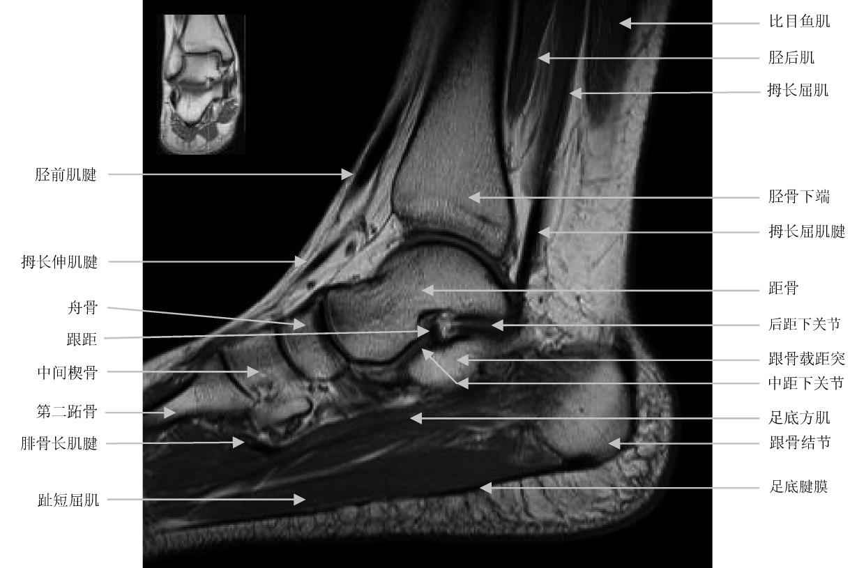 踝关节x线解剖图片