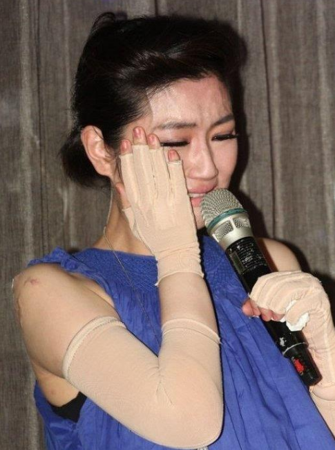 任家萱自曝11年前烧伤伤疤已好但留下不可挽回的后遗症