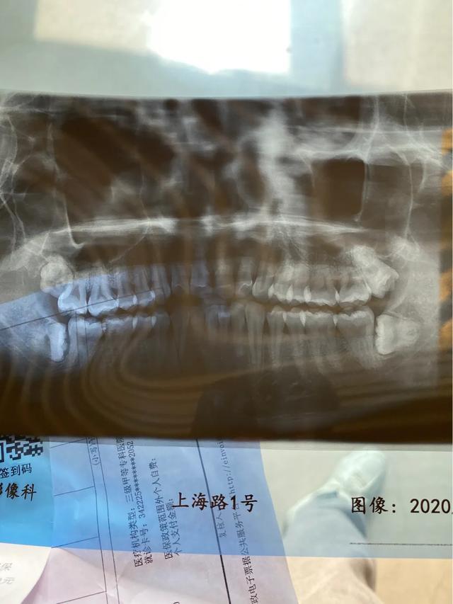 江苏省三甲口腔医院住院拔智齿体验