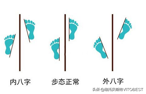 坚持这几个好习惯,把"内八""外八"的走路姿势改正回来
