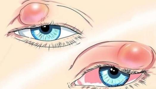眼睑的炎症能导致相当程度的不适，很难受怎么办