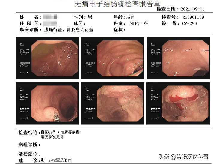 1厘米的肠息肉，6年熬成直肠癌！年过40，肠镜要做，息肉要切