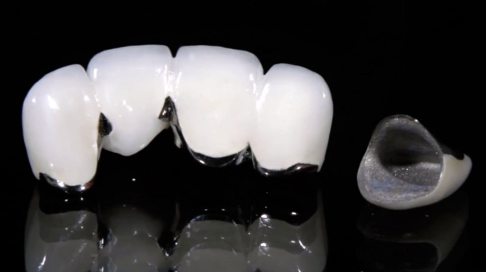 烤瓷牙/全瓷牙/牙齿贴片该选哪种?