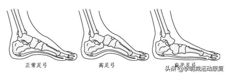 经常脚疼？可能和你脚底的一根筋有关