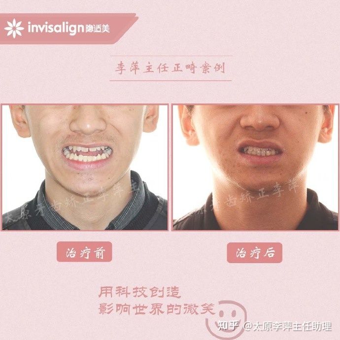 太原牙齿矫正：隐形牙套效果好不好？看这些病例你就知道了