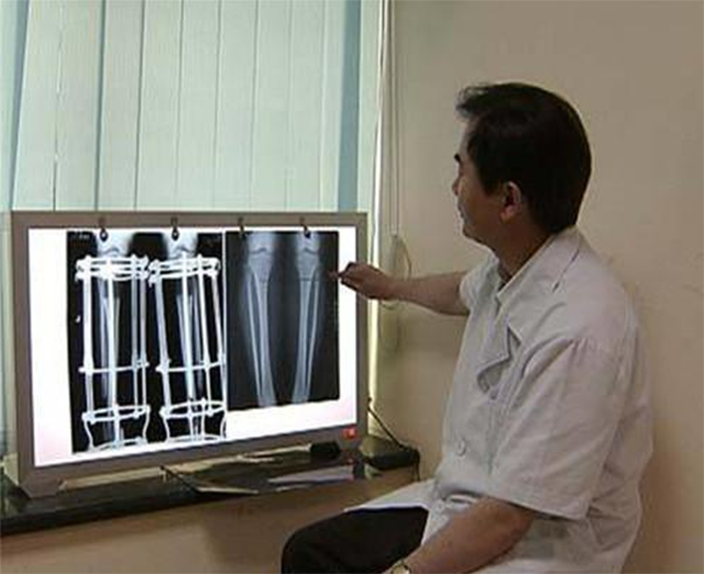 当年因矮身高自卑，花16万断骨增高7.2厘米的李亚诺，后来如何？