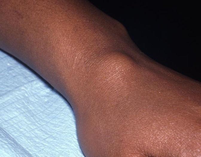 手腕鼓了一个大包,需不需要手术?骨科医生终于说了大实话!