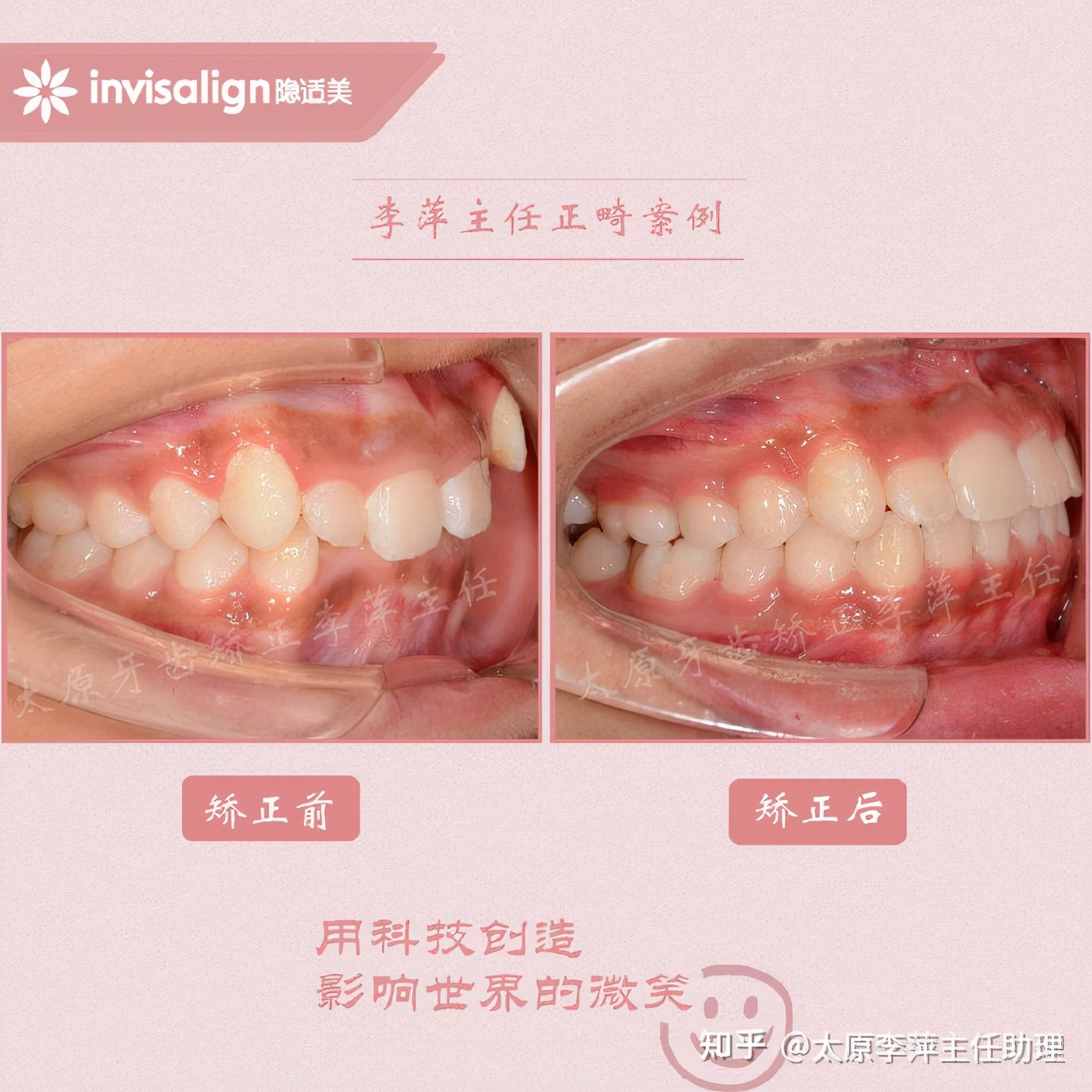 太原牙齿矫正：隐形牙套效果好不好？看这些病例你就知道了