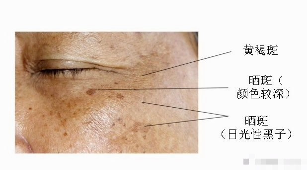晒斑、肝斑、黄褐斑，你能分清吗？