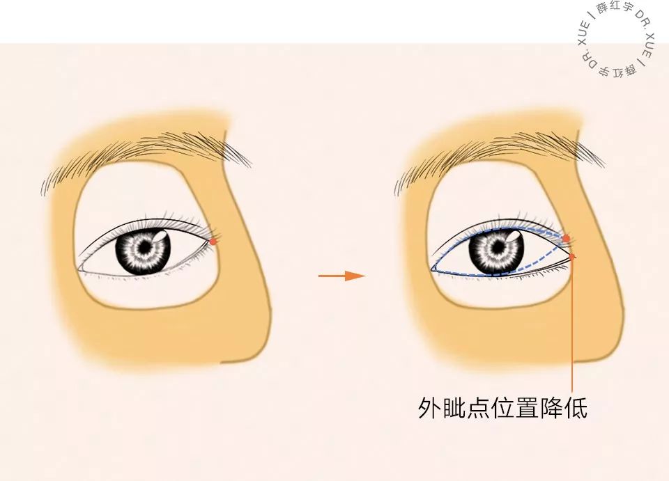 要不要开外眼角？要不要做眼睑下至？