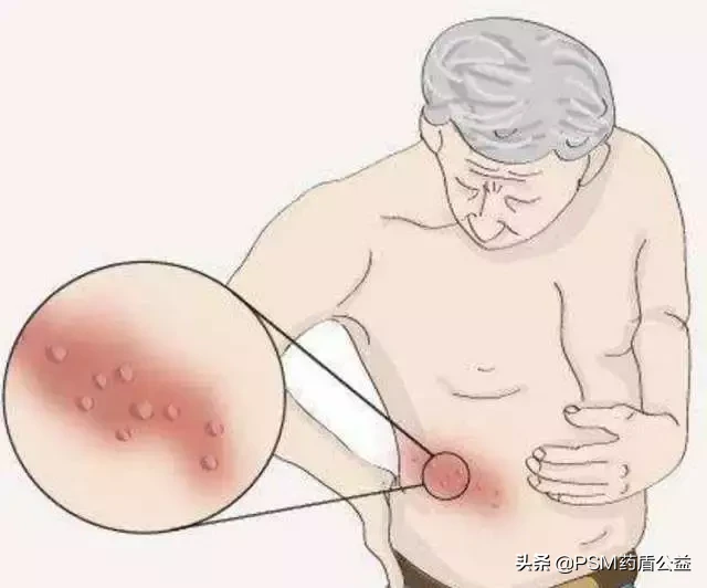 带状疱疹为何找上你?四种治疗方法在这里,有效!
