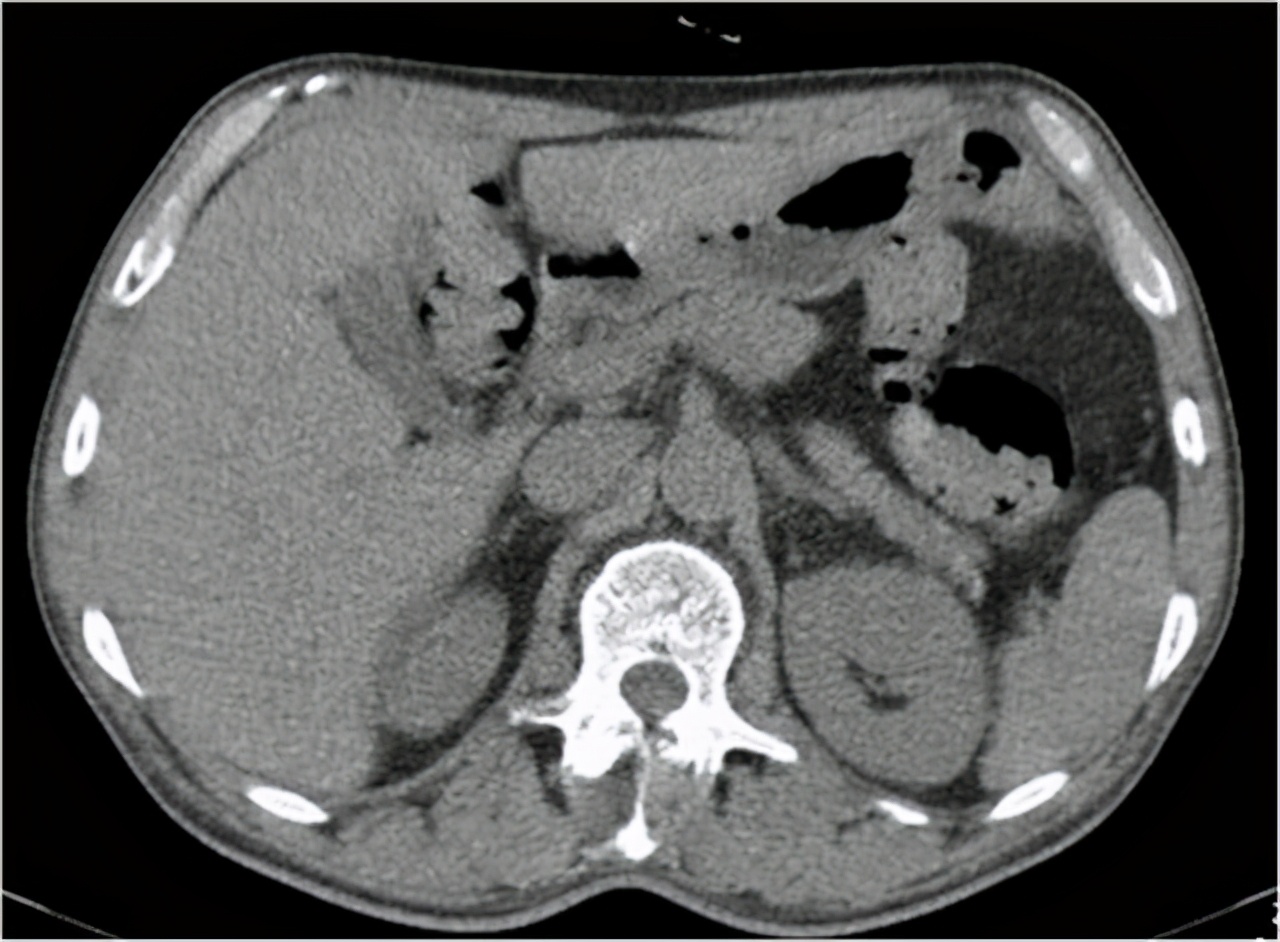 最贵的查癌神器：PET-CT，一次能查全身肿瘤，为何不建议正常人做