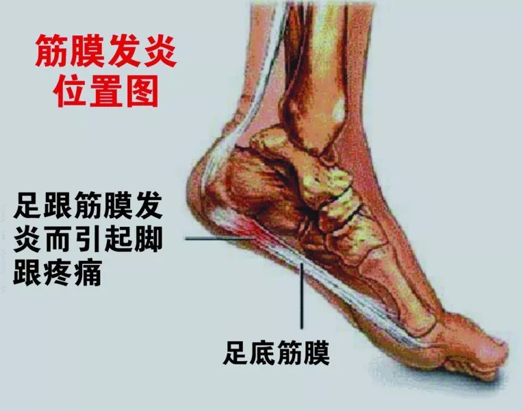右脚后跟底部疼痛？骨科医生详解常见原因