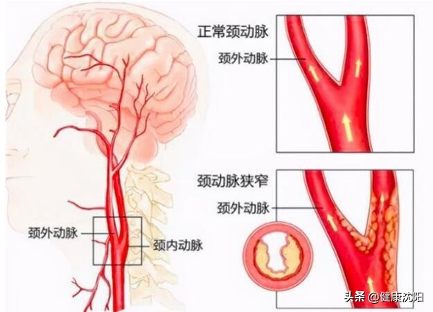 健康科普堂 | 颈动脉也可以做支架？你想知道的都在这里！