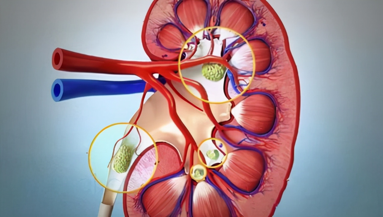 肾结石“体外碎石”并非“万能”，它的这些副作用你知道吗？