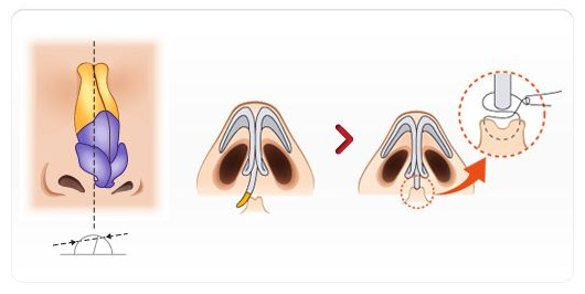 余文林：鼻子歪怎么办关于歪鼻畸形矫正