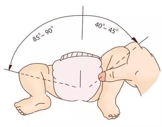 蛙式支架多少钱(发育性髋关节脱位致残率高) - 价格百科