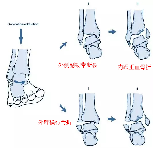 踝关节扭伤后怎么办？需要拍片子吗？要多久恢复？